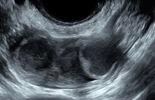ultrasound-iota