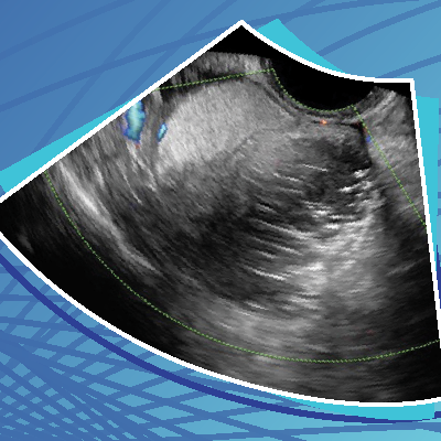 ultrasound image GYN
